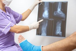 Anak Lebih Cepat Sembuh Patah Tulang Dibanding Dewasa