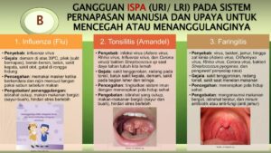Amandel dan Polip: Penyebab Gangguan Pernapasan