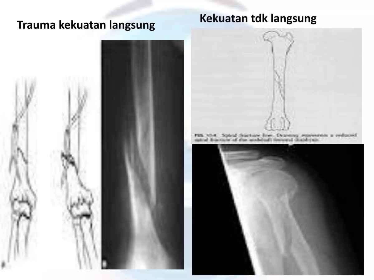 Keretakan pada tulang lengan disebut fraktura