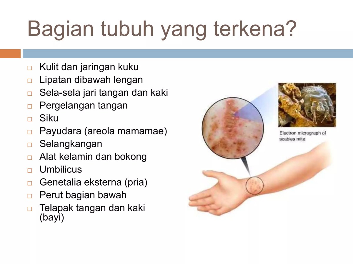 Terapi scabies dan typhus