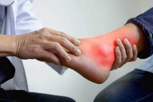 Kemungkinan Penyakit Asam Urat pada Pasien dengan Pembengkakan Send