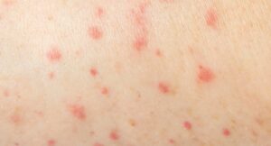 Anak dengan Demam Berdarah: Gejala dan Pencegahan Sederhana