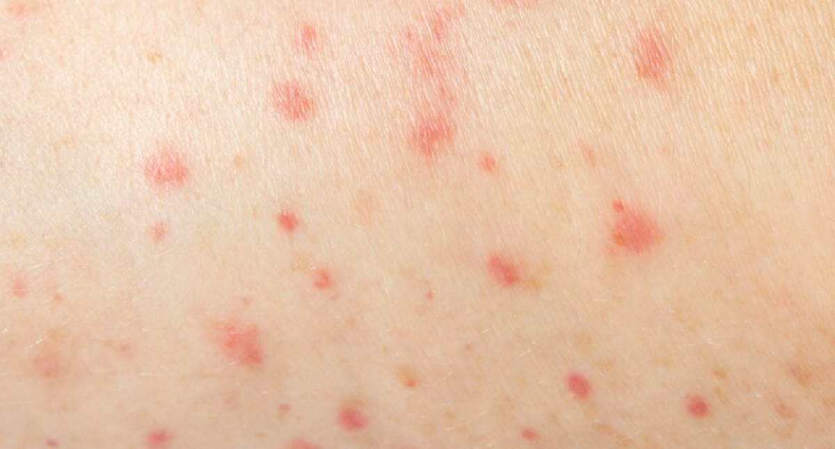 Anak dengan Demam Berdarah: Gejala dan Pencegahan Sederhana