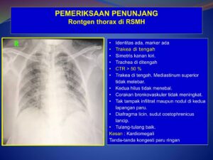 Corakan bronchovaskuler meningkat, sinus costofrenicus lancip, diafragma licin, CTR