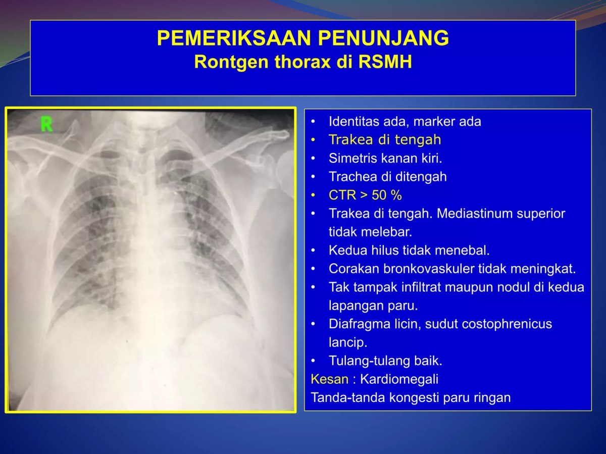 Corakan bronchovaskuler meningkat, sinus costofrenicus lancip, diafragma licin, CTR